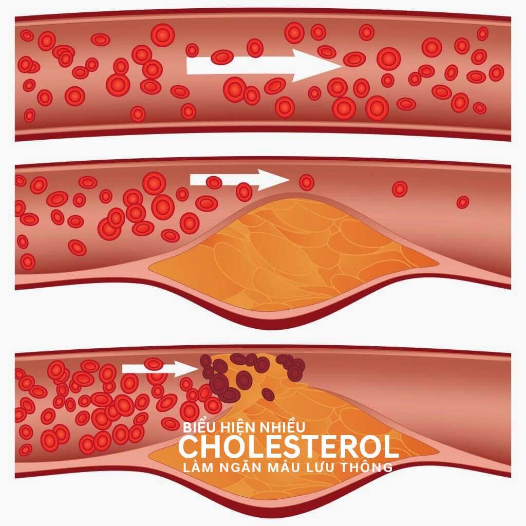Cách Giảm cholesterol hiệu quả chỉ với quả Cherry